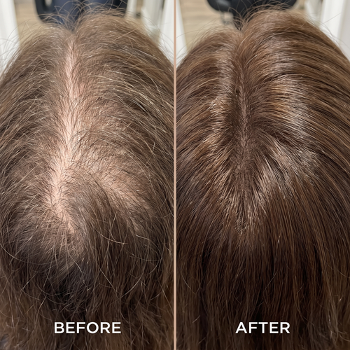 Stop Hiding Your Scalp. Bring Back The Look Of Fuller Hair.